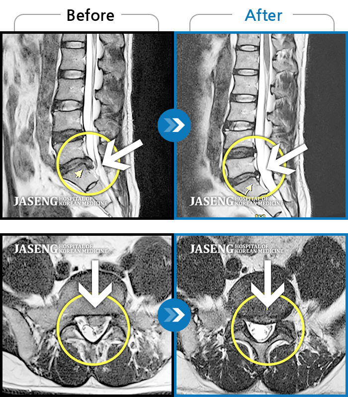 광주자생한방병원 치료사례 MRI로 보는 치료결과-허리 양측부터 골반까지 통증, 좌측 하지 발목까지 이어지는 저린감