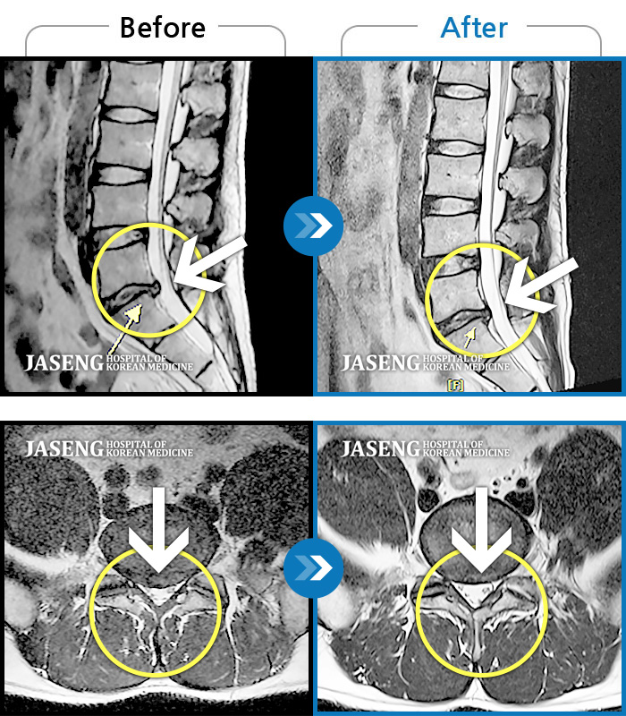 광주자생한방병원 치료사례 MRI로 보는 치료결과-허리 양측부터 골반까지 통증, 우측 하지 외측으로 이어지는 저린감