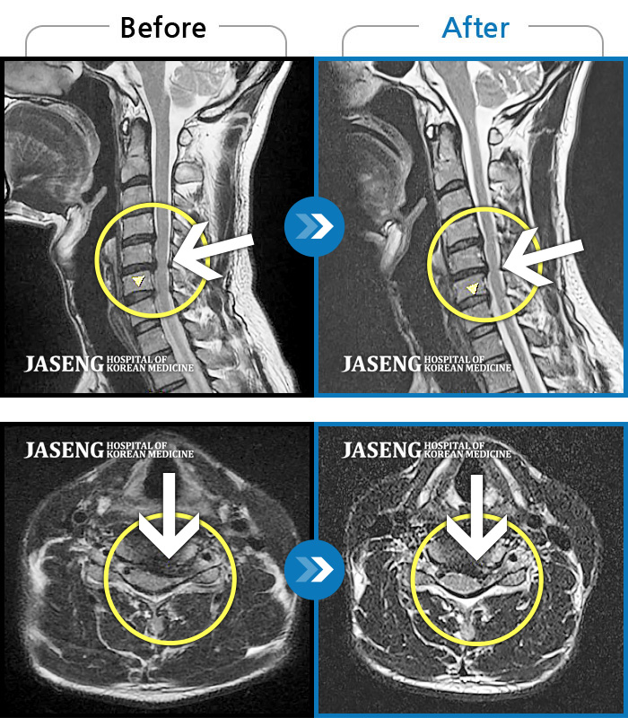광주자생한방병원 치료사례 MRI로 보는 치료결과-후경부 양측부터 승모근까지 묵직한 통증, 좌측 상지 수지까지 이어지는 저린감