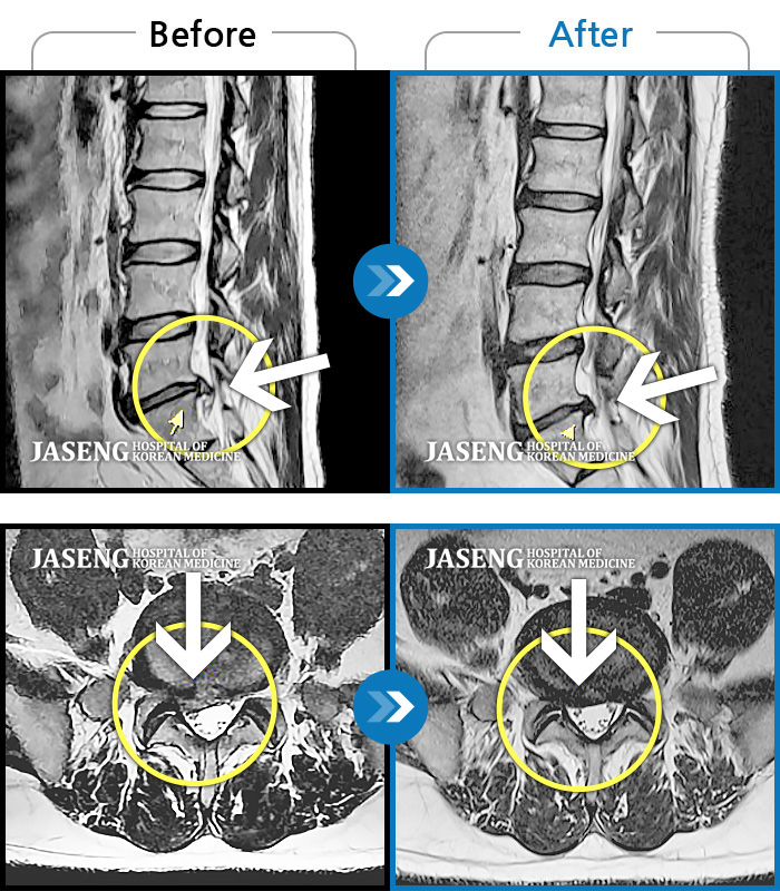 광주자생한방병원 치료사례 MRI로 보는 치료결과-허리 양측부터 골반까지 통증, 우측 하지 후면으로 이어지는 당기는 통증