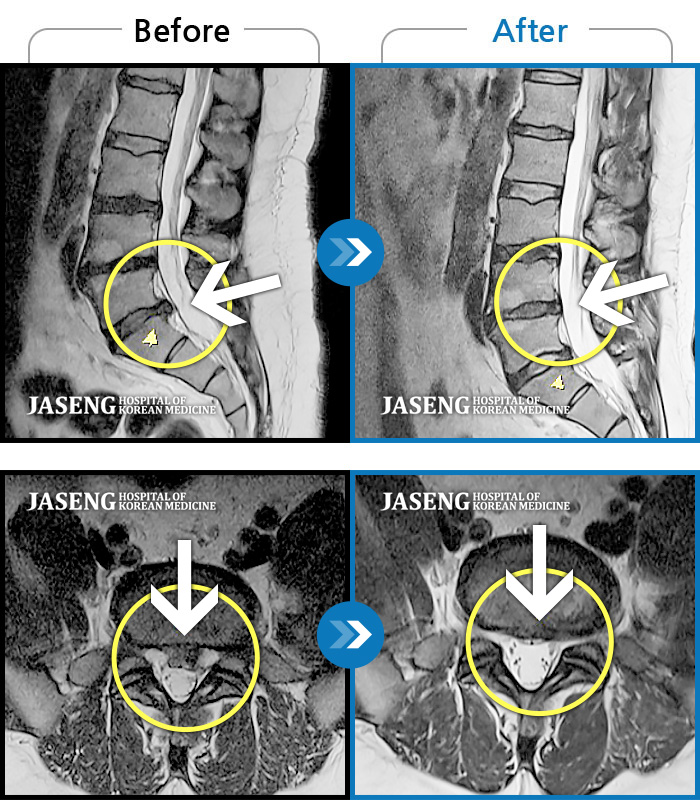 광주자생한방병원 치료사례 MRI로 보는 치료결과-좌측 허리부터 좌측 골반까지 찌릿하고 묵직한 통증, 좌측 하지 후면으로 이어지는 저린감