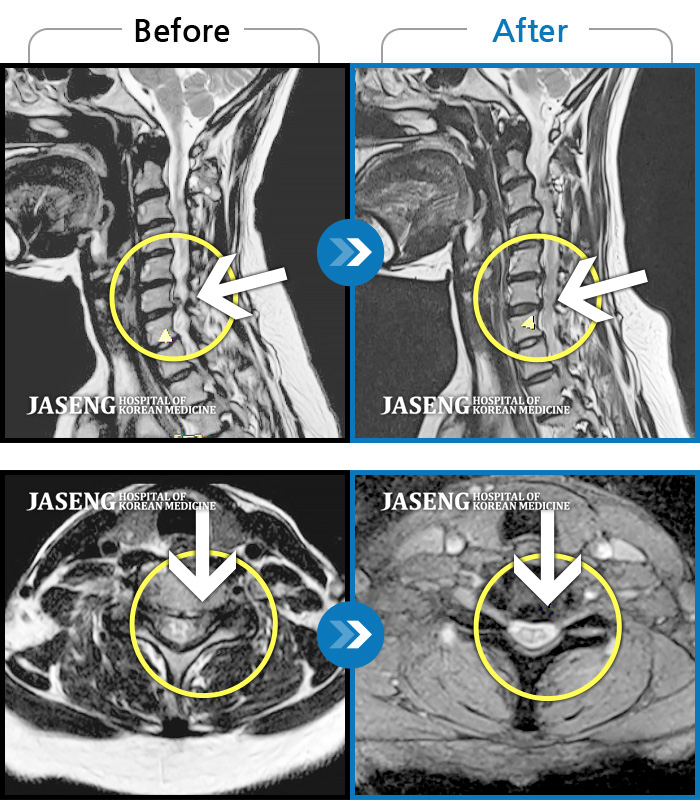 광주자생한방병원 치료사례 MRI로 보는 치료결과-우측 후경부부터 좌측 승모근까지 이어지는 뻐근한 통증, 우측 상지, 좌측 수지 힘 없는 느낌