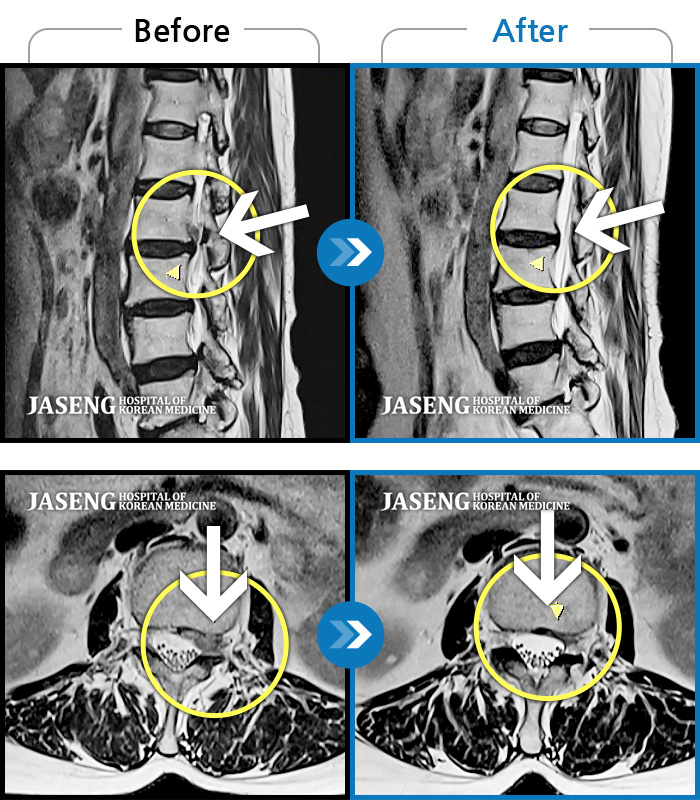 광주자생한방병원 치료사례 MRI로 보는 치료결과-양측 허리부터 양측 골반까지 묵직하고 뻐근한 통증, 좌측 하지 외측으로 이어지는 통증