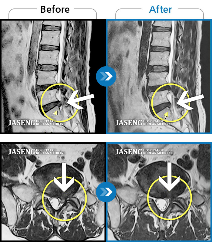 광주자생한방병원 치료사례 MRI로 보는 치료결과-좌측 허리부터 좌측 골반까지 통증, 좌측 하지 후면으로 이어지는 통증, 수면 시 욱신거리는증상 동반