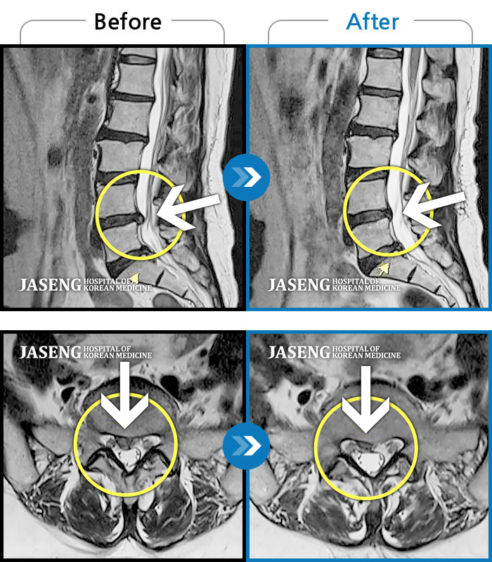 광주자생한방병원 치료사례 MRI로 보는 치료결과-양측 허리부터 양측 골반 통증, 좌측 허벅지부터 종아리 후면부 통증 및 저린감 