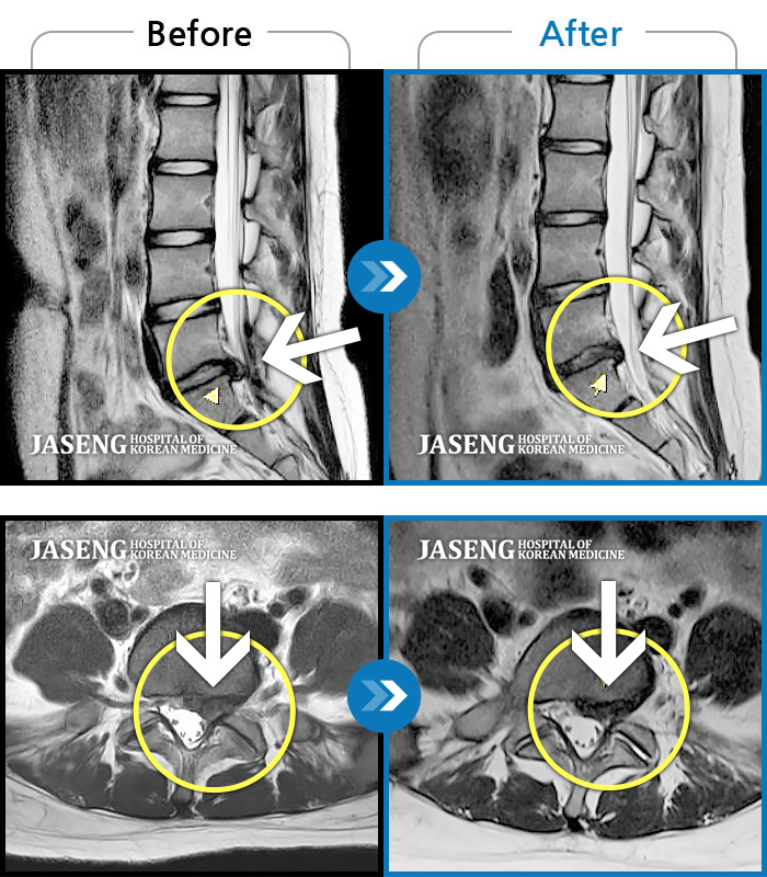 광주자생한방병원 치료사례 MRI로 보는 치료결과-양측 허리부터 양측 골반 통증, 보행 시 다리를 끄는 증상 