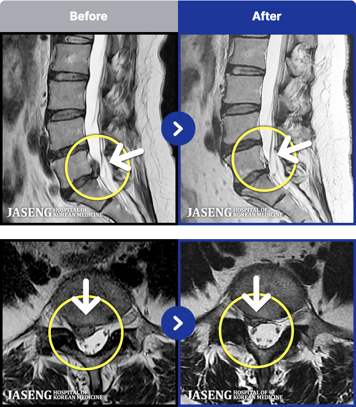 ��õ�ڻ��ѹ溴�� ġ���� MRI�� ���� ġ����-�㸮 ����� ���ſ����ϰ� ������ ������ �ٸ��� ������ �ִ�.