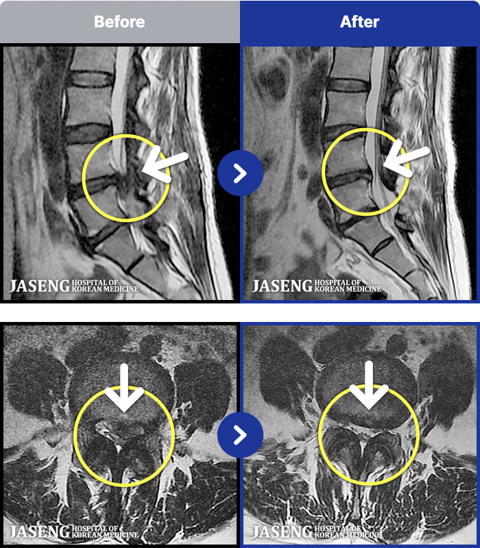 �ϻ��ڻ��ѹ溴�� ġ���� MRI�� ���� ġ����-�㸮, ���� ��ݺ��� ���� �ٸ��� ���� �� ������ ���ӵǰ�, ���� �ٸ��� ���� ������, ������ ���Ͽ�����, 