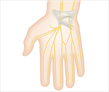 광주자생한방병원 기타관절질환 손목터널증후군-손목터널증후군에 관련된 이미지 입니다.