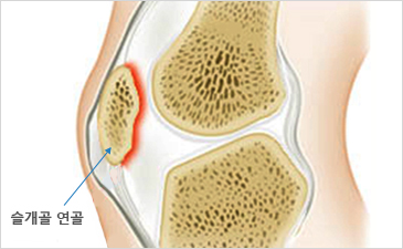 광주자생한방병원 무릎질환 슬개골연골연화증-슬개골 연골이 위치해 있는 무릎 설명 이미지