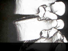 광주자생한방병원 허리질환 퇴행성디스크-정상척추에 관련된 이미지 입니다.