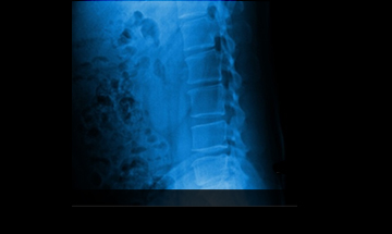 광주자생한방병원 허리질환 척추후만증-척추후만증에 관련된 이미지 입니다.