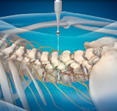 광주자생한방병원 허리치료법 신경근회복술-신경근회복술의 특징 두번째 관련 사진 입니다.