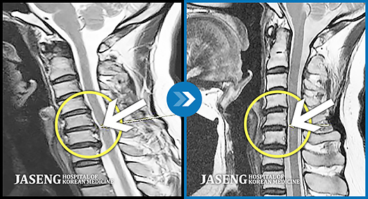 경추 5,6번 우측에서 디스크가 탈출한 경우의 MRI 사진