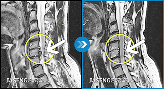 경추 디스크가 탈출, 신경막을 압박한 경우의 MRI 사진