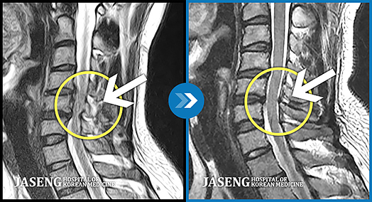 심한 통증으로 팔을 들어올리지 못하는 경우의 MRI 사진