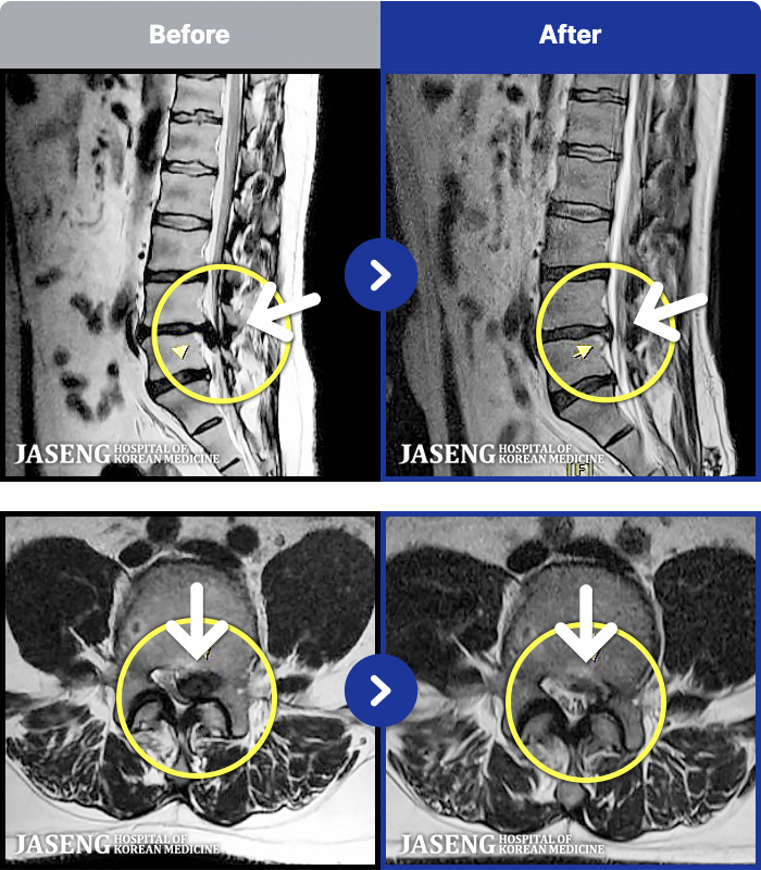 광주자생한방병원 MRI 치료 전후 사례